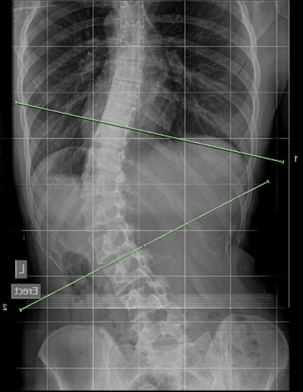 Augmented Lehnert-Schroth Classifications - 4CTL